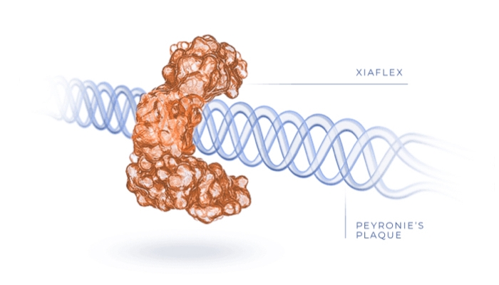 How XIAFLEX tries to break down peyronie's plaque